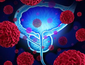 Novembro Azul - Mortes anuais por câncer de próstata no Brasil podem mais que dobrar em 2040